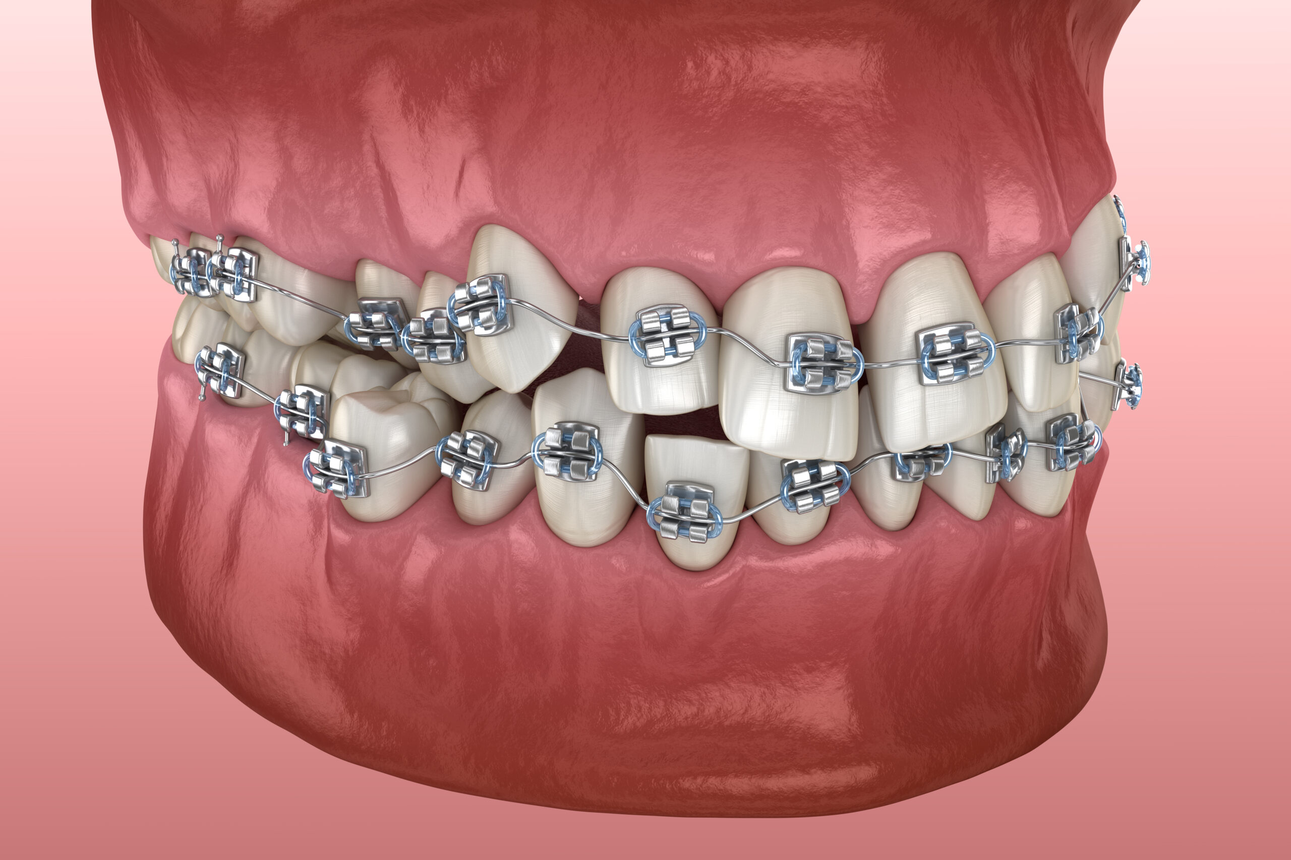 Can orthodontics improve a misaligned jaw - The London Centre for Cosmetic Dentistry