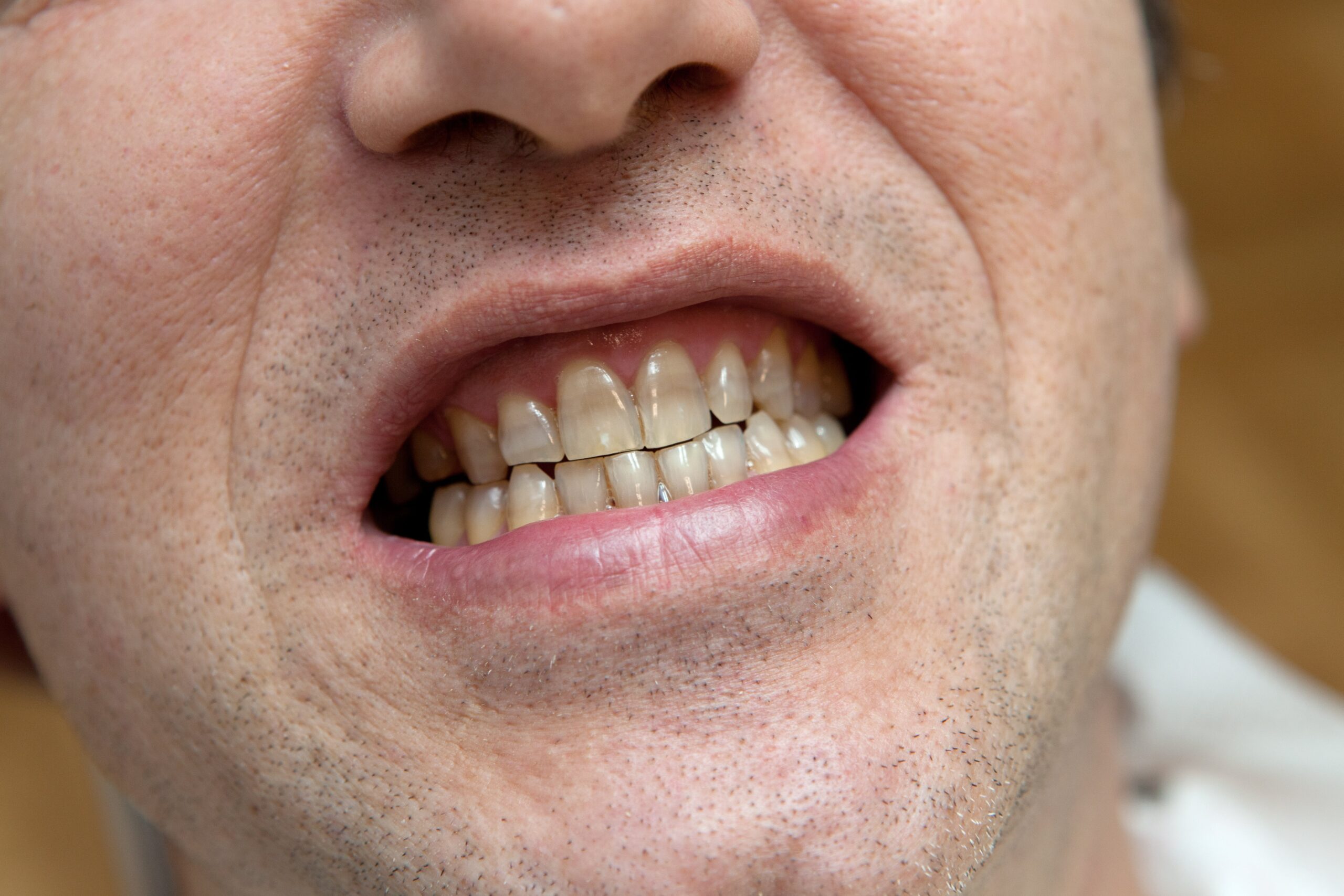 Does Teeth whitening damage enamel? - LCCD